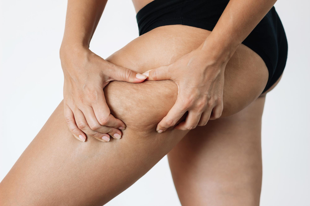 Diferencias entre celulitis, grasa localizada y flacidez