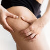 4 Tipos de Celulitis ¿Cómo identificarlos y qué puedes hacer