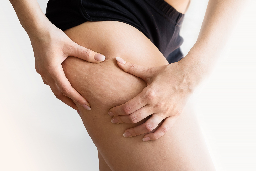 4 Tipos de Celulitis ¿Cómo identificarlos y qué puedes hacer