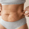 ¿A qué edad aparece la celulitis