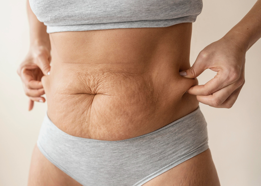 ¿A qué edad aparece la celulitis